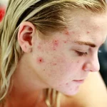 Acné : Comprendre Prévenir et Traiter les Boutons