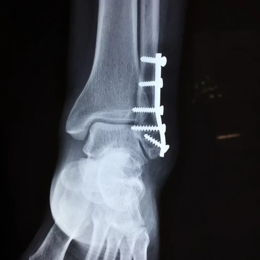 Comprendre les Fractures Causes Traitements Prévention, apprenez à identifier leurs causes, www.ecoledesecours.ch 079-535-13-71