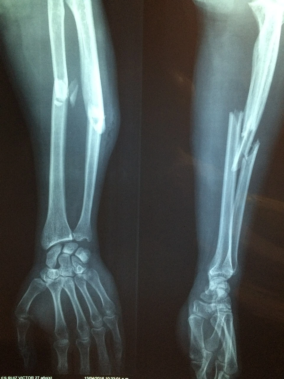 les fractures les plus courantes cours de secourisme tous les WE et en semaine www.ecoledesecours.ch 079-535-13-71