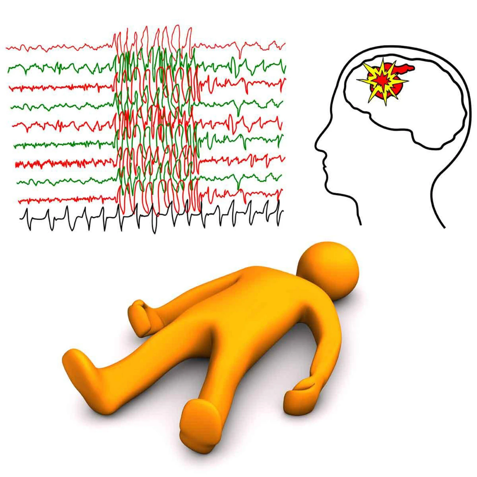 Réagir face à l'épilepsie, un phénomène neurologique qui affecte des millions de personnes. www.ecoledesecours.ch 079-535-13-71