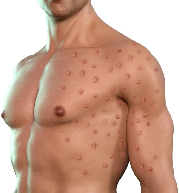 La variole du singe, aussi connue sous le nom de "monkeypox", est une maladie virale rare .www.ecoledesecours.ch 079-535-13-71