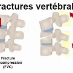 Fracture de la Colonne Vertébrale, lésions graves un des segments les plus critiques du corps humain .www.ecoledesecours.ch 079-535-13-71