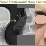 La fracture du nez , appelée fracture nasale, est l'une des fractures les plus fréquentes du visage. .www.ecoledesecours.ch 079-535-13-71
