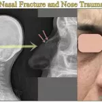 La fracture du nez , appelée fracture nasale, est l'une des fractures les plus fréquentes du visage. .www.ecoledesecours.ch 079-535-13-71