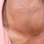 Urgence œdème de Quincke : découvrez les causes, symptômes et traitements. Que faire en cas d'urgence ? www.ecoledesecours.ch 079-535-13-71