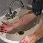 Connaître les différentes brûlures cours de secourisme assurés par des professionnels de santé www.ecoledesecours.ch 079-535-13-71