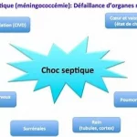 Comprendre le choc Septique, urgence médicale grave résultant d’une infection généralisée www.ecoledesecours.ch ou 079-535-13-71