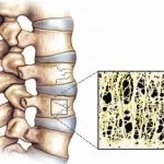 Comprendre fractures et ostéoporose ,intimement liées, notamment chez les personnes âgées www.ecoledesecours.ch 079-535-13-71