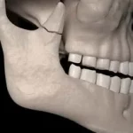 Fracture de la Mâchoire, appelée fracture mandibulaire, une blessure fréquente du visage. .www.ecoledesecours.ch 079-535-13-71