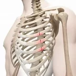 La fracture des côtes, blessure fréquente, souvent causée par un traumatisme thoracique..www.ecoledesecours.ch 079-535-13-71
