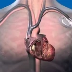 Sauveur technologique le Pacemaker, stimulateur cardiaque, petite révolution médicale qui sauve des vies. www.ecoledesecours.ch 079-535-13-71
