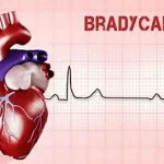 Mieux comprendre la Bradycardie, condition médicale caractérisée par un rythme cardiaque lent. www.ecoledesecours.ch 079-535-13-71