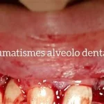 Causes de traumatismes dentaires, blessure fréquente des dents, gencives et les structures environnantes.www.ecoledesecours.ch 079-535-13-71