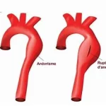 Urgence médicale rupture Anévrisme , rupture d’un vaisseau sanguin , provoquant une hémorragie interne www.ecoledesecours.ch 079-535-13-71