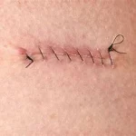 Comprendre points de suture, une technique médicale essentielle pour fermer les plaies profondes www.ecoledesecours.ch 079-535-13-71