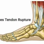 Rupture du tendon d'Achille, blessure fréquente, notamment chez les sportifs et les personnes actives www.ecoledesecours.ch 079-535-13-71