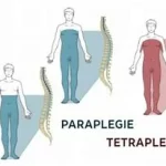Paraplégie et tétraplégie différences, paralysie qui résultent d’une lésion de la moelle épinière. www.ecoledesecours.ch 079-535-13-71