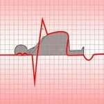 Infarctus myocarde et séquelles, une urgence médicale causée par une obstruction des artères coronaires . www.ecoledesecours.ch 079-535-13-71