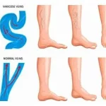 Rupture varices et hémorragies, un phénomène inquiétant qui peut entraîner une hémorragie importante.. www.ecoledesecours.ch 079-535-13-71