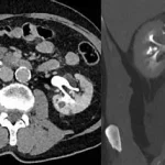 Rupture du Rein Urgence, une urgence médicale rare mais grave qui survient lors d'un traumatisme www.ecoledesecours.ch 079-535-13-71