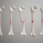 Fracture ouverte que faire ?, urgence médicale qui nécessite une prise en charge rapide. www.ecoledesecours.ch 079-535-13-71