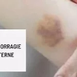 Hémorragie interne que faire ? une perte de sang à l’intérieur du corps, souvent invisible à l’œil nu.. www.ecoledesecours.ch 079-535-13-71
