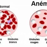 Anémie Causes Symptômes Traitements, une affection fréquente, une diminution du taux d'hémoglobine www.ecoledesecours.ch 079-535-13-71