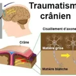 Traumatisme crânien que faire, certains sont bénins, d’autres peuvent entraîner des complications graves. www.ecoledesecours.ch 079-535-13-71