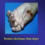 Brûlure électrique que faire ? Ce type de blessure peut être grave, même si les signes visibles sont minimes 079-535-13-71