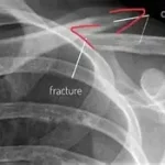 Fracture Clavicule que faire ? une des blessures osseuses les plus fréquentes, notamment chez les sportifs www.ecoledesecours.ch