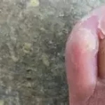Ongle incarné que faire ? Cette situation provoque douleur, rougeur, gonflement, voire infection www.ecoledesecours.ch 079-535-13-71