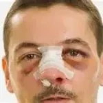 Fracture Nez que faire ? appelée fracture des os nasaux, est l’une des blessures faciales les plus fréquentes. www.ecoledesecours.ch
