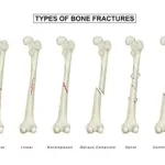 Fracture fémorale que faire ? une des blessures osseuses les plus graves est l’os le plus long et solide du corps. www.ecoledesecours.ch