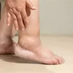 Oedèmes jambes que faire ? gonflement visible, souvent accompagné d’une sensation de lourdeur ou de tension cutanée.. www.ecoledesecours.ch