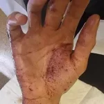 Brûlure chimique que faire ? substance corrosive acide, base ou solvant — entre en contact avec la peau. 079-535-13-71 www.ecoledesecours.ch