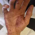 Brûlure chimique que faire ? substance corrosive acide, base ou solvant — entre en contact avec la peau. 079-535-13-71 www.ecoledesecours.ch