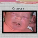 Bébé devient bleu que faire ? appelé cyanose, traduit un manque d’oxygène dans le sang. 079-535-13-71 www.ecoledesecours.ch