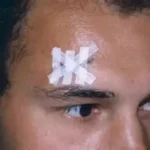 Arcade sourcilière ouverte que faire ? fréquente lors de chutes, coups ou d’accidents sportifs 079-535-13-71 www.ecoledesecours.ch