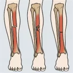 Fracture du tibia que faire ? blessures osseuses les plus fréquentes, notamment chez les sportifs 079-535-13-71 www.ecoledesecours.ch