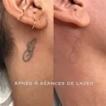 Détatouage et effets secondaires une pratique de plus en plus courante, motivée par un changement de goût. www.ecoledesecours.ch 079-535-13-71