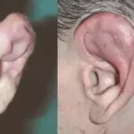 Hématome de l'oreille que faire ? ou « oreille en chou-fleur », accumulation de sang entre le cartilage le pavillon de l’oreille.