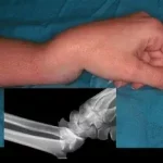 Reconnaître une Fracture fermée, blessure avec l' os qui se casse sans que la peau ne soit ouverte www. ecoledesecours.ch 079-535-13-71
