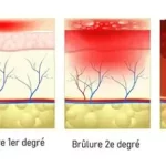 Reconnaître les différentes brûlures, reconnaître les différentes brûlures pour adopter les bons gestes et limiter les complications
